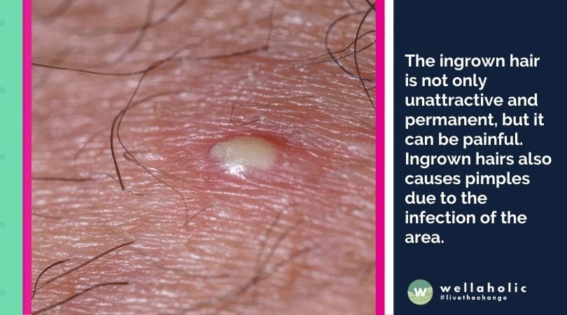 The ingrown hair is not only unattractive and permanent, but it can be painful. Ingrown hairs also causes pimples due to the infection of the area.